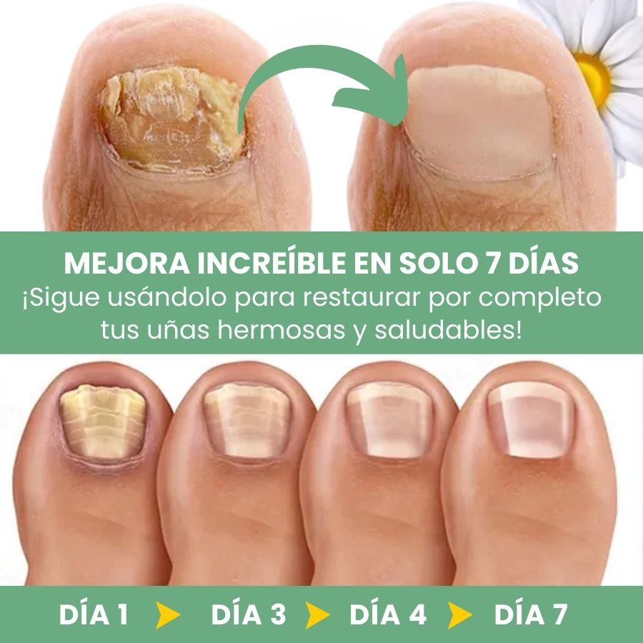 FungBoost™ | Gel para el Tratamiento de Hongos en las Uñas