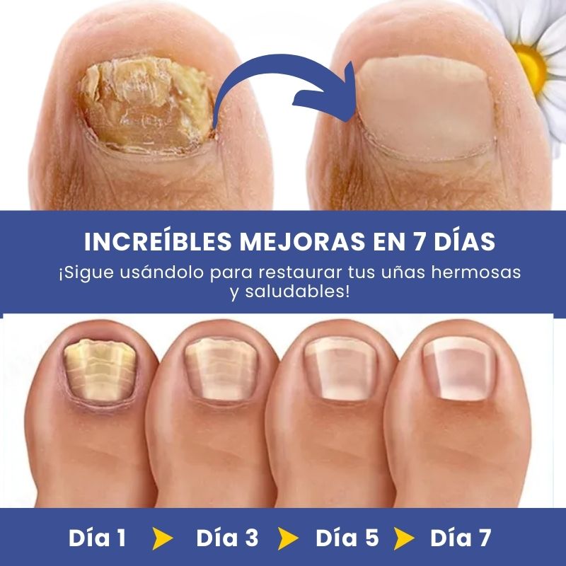 NagelFixer™ | Roll-on para el cuidado de las uñas